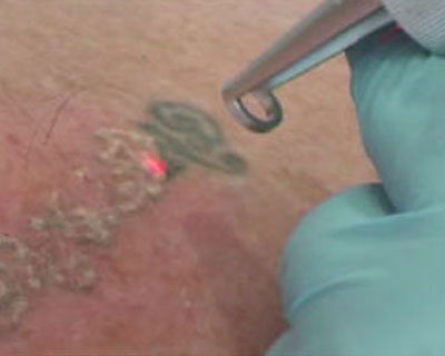 Laser Tattoo Removal Training