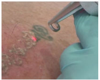 Laser Tattoo Removal